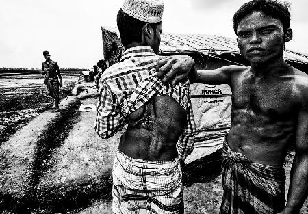 Rohingya refugee showing the impact of a bullet in his friend´s body - Bangladesh